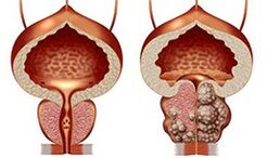 Prostate saine et malsaine