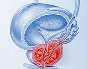 inflammation de la prostate avec prostatite